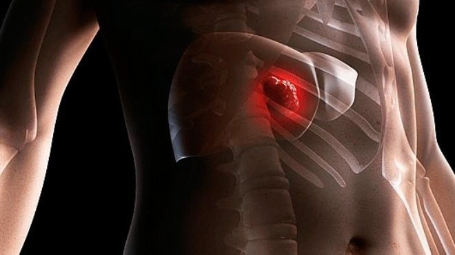 علاج أورام الكبد بالحقن الأسمنتي